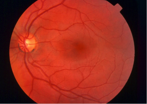 diabetic-retinopathy-1