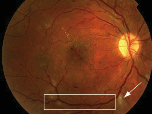 diabetic-retinopathy-2