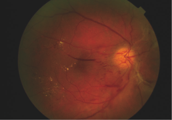 diabetic-retinopathy-3