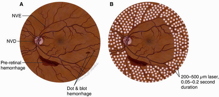 diabetic-retinopathy-4