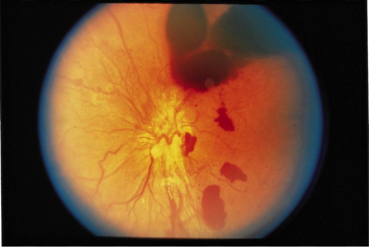 diabetic-retinopathy-5