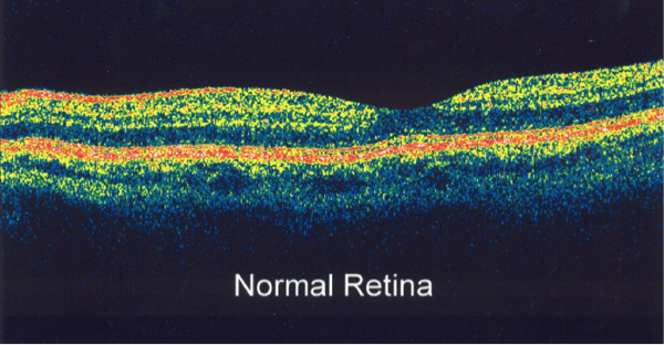 diabetic-retinopathy-7